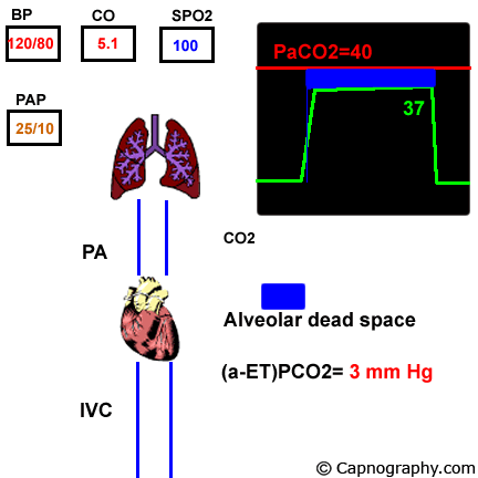 alveolar dead space paco2